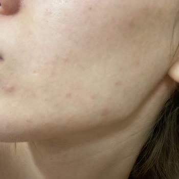 Krem Cildimde Sivilce Ve Kızarıklık Yaptı, İade Talep Ediyorum