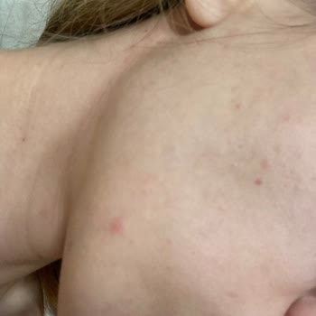 Krem Cildimde Sivilce Ve Kızarıklık Yaptı, İade Talep Ediyorum