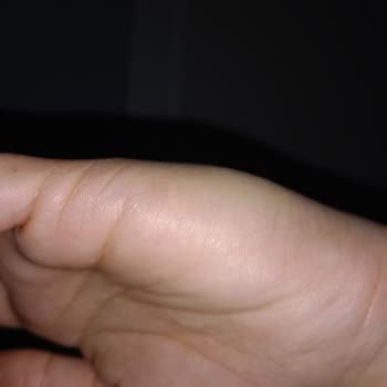 Atos Otel'de Tahtakurusu Isırığı Nedeniyle Sağlık Ve Maddi Mağduriyet