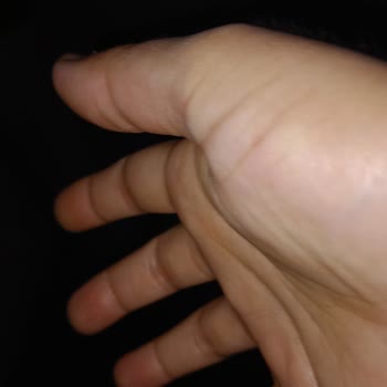 Atos Otel'de Tahtakurusu Isırığı Nedeniyle Sağlık Ve Maddi Mağduriyet