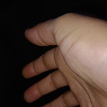 Atos Otel'de Tahtakurusu Isırığı Nedeniyle Sağlık Ve Maddi Mağduriyet