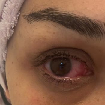 Bebek Şampuanında 'Göz Yakmaz' İddiası ve Göz Yanması Sorunu