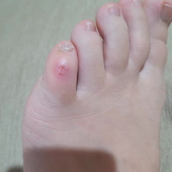 Bir Kez Giydiğim Sandalet Parmaklarımı Yaraladı İade Talebim Reddedildi