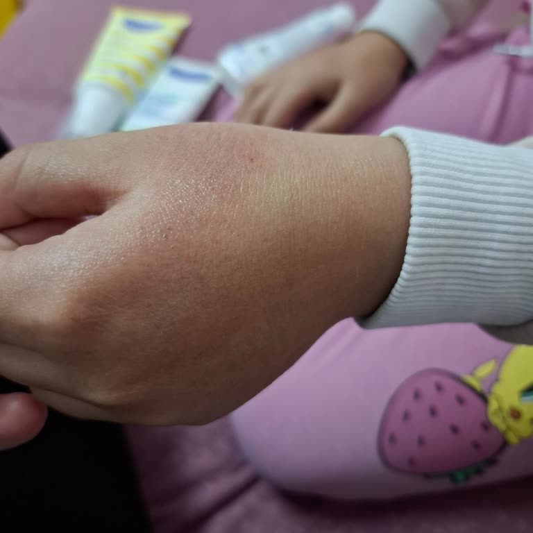Mustela Krem Sonrası Kızımda Ciddi Kızarıklık Ve Kuruluk Oluştu