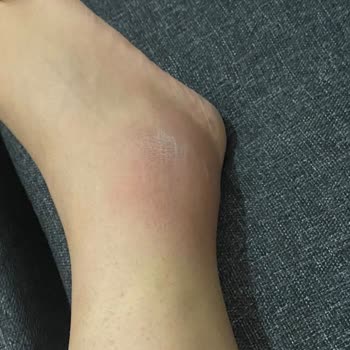 İlk Kullanımda Ciddi Rahatsızlık Ve İltihap Yapan Ayakkabı İçin İade Talebi