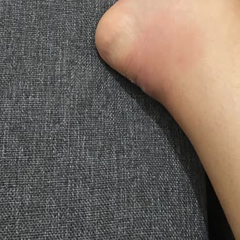 İlk Kullanımda Ciddi Rahatsızlık Ve İltihap Yapan Ayakkabı İçin İade Talebi