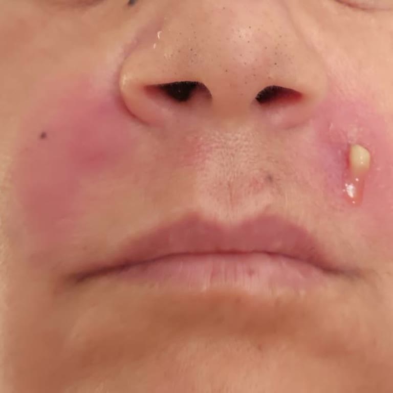 Yanak Dolgusu Sonrası İltihap Ve İlgisiz Salon Nedeniyle Maddi Manevi Mağduriyet