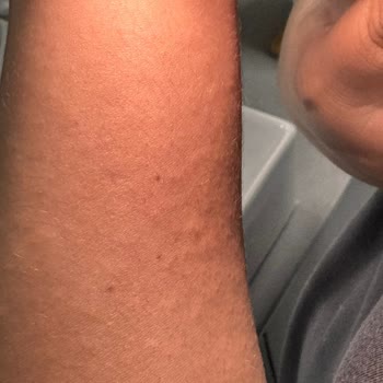 Vücut Losyonu Kullanımında Şiddetli Alerjik Reaksiyon Ve İade Talebi