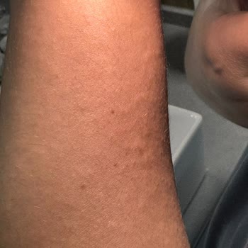Vücut Losyonu Kullanımında Şiddetli Alerjik Reaksiyon Ve İade Talebi