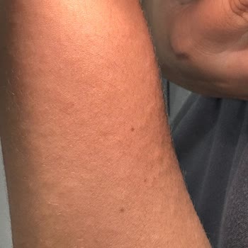 Vücut Losyonu Kullanımında Şiddetli Alerjik Reaksiyon Ve İade Talebi