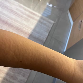 Vücut Losyonu Kullanımında Şiddetli Alerjik Reaksiyon Ve İade Talebi