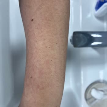 Vücut Losyonu Kullanımında Şiddetli Alerjik Reaksiyon Ve İade Talebi