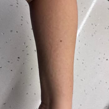 Vücut Losyonu Kullanımında Şiddetli Alerjik Reaksiyon Ve İade Talebi