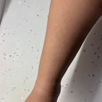 Vücut Losyonu Kullanımında Şiddetli Alerjik Reaksiyon Ve İade Talebi