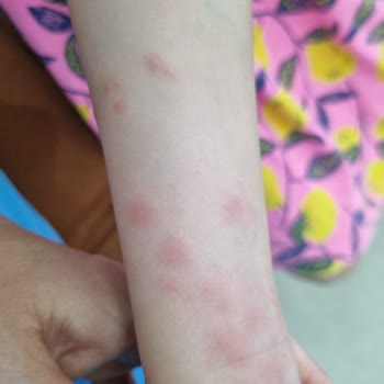 Koltuk Takımında Bitmeyen Tahtakurusu Sorunu Ve İade Talebi