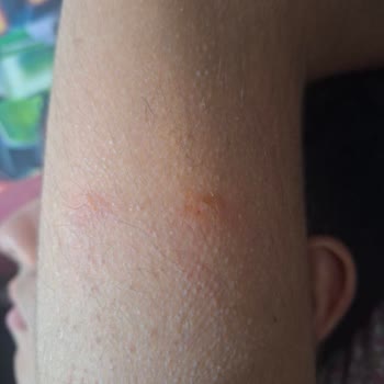 Ağrı Bandı Ciddi Alerjik Reaksiyonlara Sebep Oldu, Firmadan Yanıt Alınamıyor