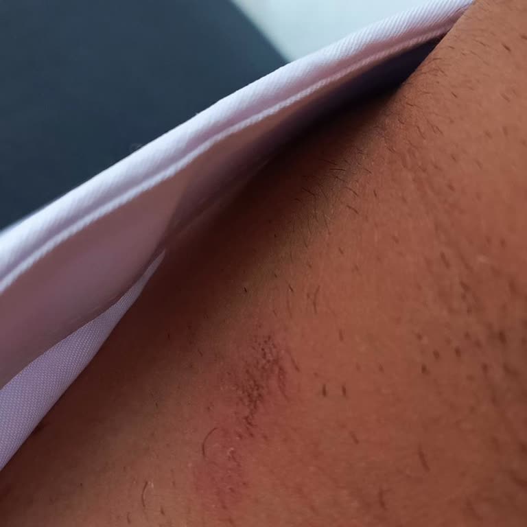 Sesu Tüy Dökücü Krem Boynumda Yanık Ve Yaralara Sebep Oldu