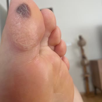 Kısa Sürede Deforme Olan Babet İçin İade Reddedildi, Mağduriyet Yaşıyorum