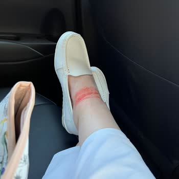 Toyota Corolla Hybrid Galaxy Rear Seat Burn Incident Ignored by Service and Customer Care