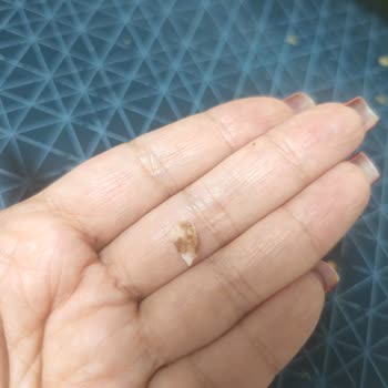 Dana Kavurmadan Çıkan Kemik Parçası Nedeniyle Yaşanan Sağlık Riski