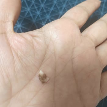 Dana Kavurmadan Çıkan Kemik Parçası Nedeniyle Yaşanan Sağlık Riski