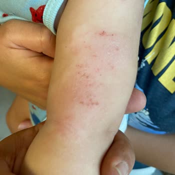 Mustela Stelatopia Cream and Newborn Shampoo Caused Red Spots on Baby’s Skin