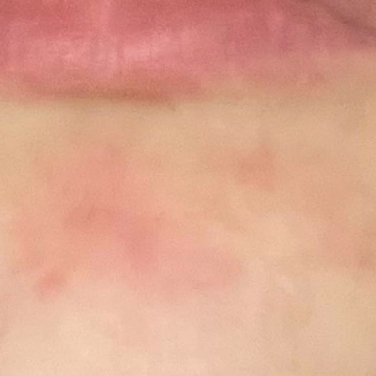 Cream Co Nemlendirici Ciltte Şiddetli Reaksiyona Sebep Oldu