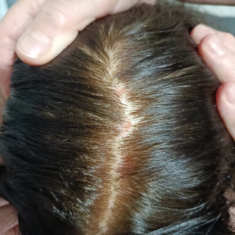 Saç Boyası Kullanımı Sonrası Ciddi Saç Derisi Yaralanması Ve Mağduriyet