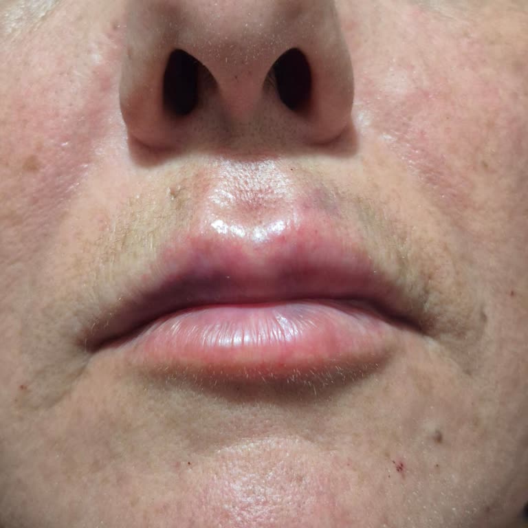 Dudak Dolgusu Sonrası Asimetri, Morluk Ve Sertlik Yaşadım, Ücret İadesi İstiyorum