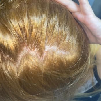 Saç Boyası Kullanımı Sonrası Ciddi Yanma Ve Yaralar Oluştu