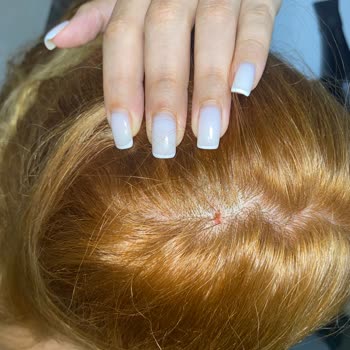 Saç Boyası Kullanımı Sonrası Ciddi Yanma Ve Yaralar Oluştu