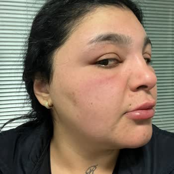 Saç Boyası Sonrası Ciddi Alerji Ve Hastane Süreci Yaşadım