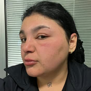 Saç Boyası Sonrası Ciddi Alerji Ve Hastane Süreci Yaşadım