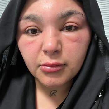 Saç Boyası Sonrası Ciddi Alerji Ve Hastane Süreci Yaşadım