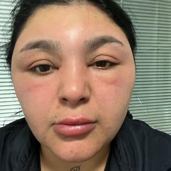 Saç Boyası Sonrası Ciddi Alerji Ve Hastane Süreci Yaşadım