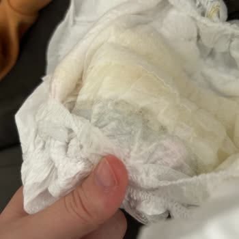 Molfix Bebek Bezinden Çıkan Tanecikler Bebeğimin Sağlığını Tehdit Ediyor