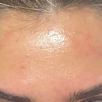 Dermokil Matcha Özlü Kil Maskesi Cildimde Kızarıklık Ve İz Oluşturdu