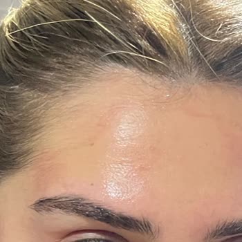 Dermokil Matcha Özlü Kil Maskesi Cildimde Kızarıklık Ve İz Oluşturdu