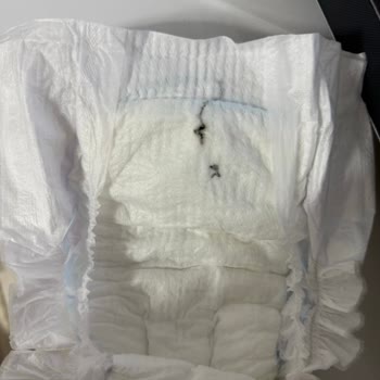 Bebek Bezinde Çıkan Siyah Cisim Nedeniyle Endişe Ve Hızlı Çözüm Talebi