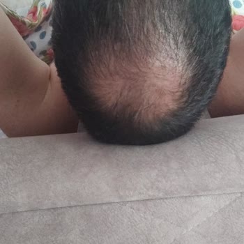 Esteworld Saç Ekimi Sonrası Sonuç Alamadım Ve Geri Dönüş Yapılmıyor