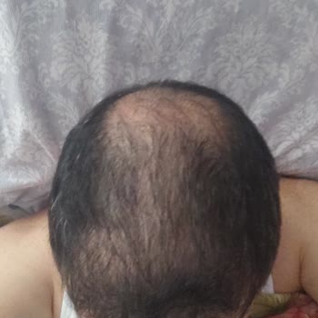 Esteworld Saç Ekimi Sonrası Sonuç Alamadım Ve Geri Dönüş Yapılmıyor