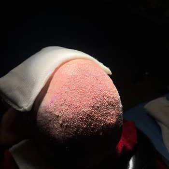 Esteworld Saç Ekimi Sonrası Sonuç Alamadım Ve Geri Dönüş Yapılmıyor