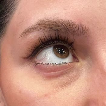 Estee Lauder Göz Kremi Göz Çevremde Şişlik Ve Dökülme Yaptı, Çözüm Bekliyorum