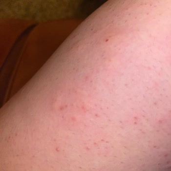 Severe Allergic Reaction After Using Veet Men Sensitive Skin Hair Removal Cream