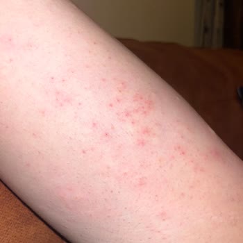 Severe Allergic Reaction After Using Veet Men Sensitive Skin Hair Removal Cream