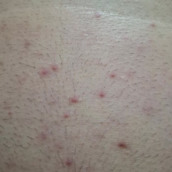 Veet Men Hair Removal Cream Caused Allergic Reaction and Rash After Use