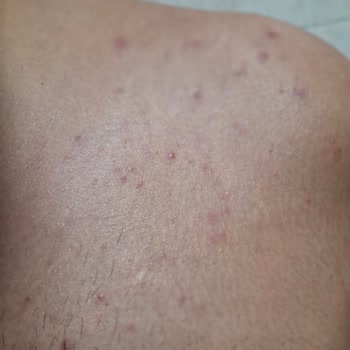 Veet Men Hair Removal Cream Caused Allergic Reaction and Rash After Use