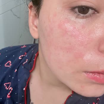 Arbutin Serum Sonrası Yüzde Yanma Ve Satıcıdan Geri Dönüş Alamadım