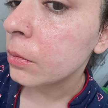 Arbutin Serum Sonrası Yüzde Yanma Ve Satıcıdan Geri Dönüş Alamadım