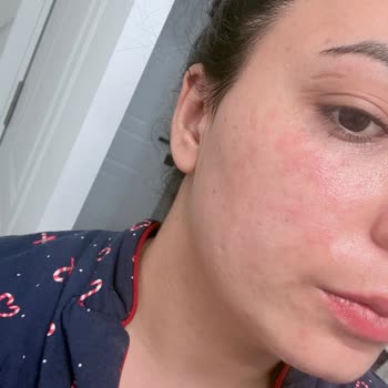 Arbutin Serum Sonrası Yüzde Yanma Ve Satıcıdan Geri Dönüş Alamadım